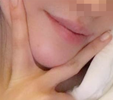 顎先手術を受けて顔が細くなったのはもちろん、印象まで変わりました