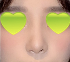 鼻の手術をしたのですが、うまくいったか見てください ^^