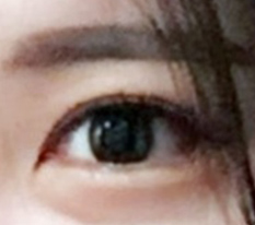 I honestly want to recommend dual canthoplasty;;