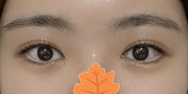 インアウトラインの二重手術、成功しました！ㅎㅎㅎ