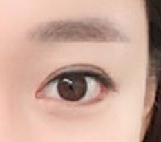 I had revision canthoplasty at 現代美学整形外科, the best~