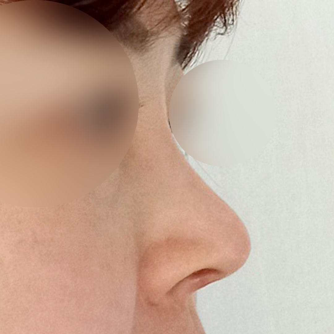 まとまったお金を貯めて現代美学整形外科で鼻整形しました