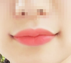 I had mouth-corner surgery