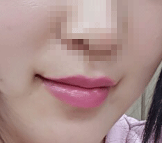 口角整形レビューを載せます~