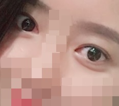 目の修正手術＋眼瞼下垂矯正