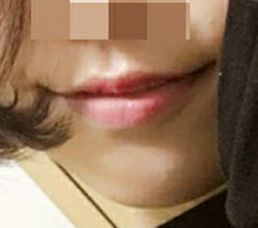 現代美学で口角手術を受けて本当によかったと思います 笑