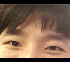 目の手術の体験談です ㅋ