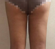 Liposuction is the answer for escaping lower-body heaviness
