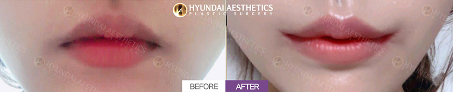 口角挙上