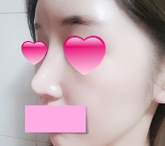 鼻の再手術レビュー~~
