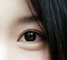 目の再手術、成功してますよね？？ ㅎㅎ