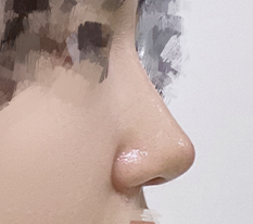 鼻手術してよかったですㅎㅎ