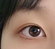 二重手術から3ヶ月でまたレビューに来ました