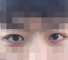 欲しかった二重