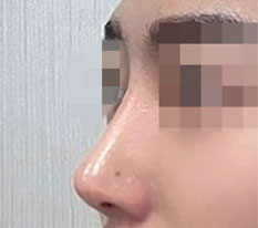 鼻の手術後、イケメンになったってよく言われます