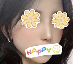 現代美学整形外科で鼻整形してから7ヶ月経ちました ㅎㅎㅎ
