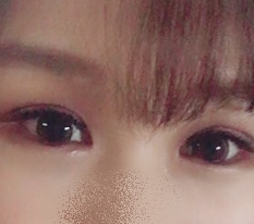 二重まぶた手術で目が変わりました ♥