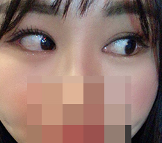 デュアル切開は本当に印象がかなり変わるみたいです^^