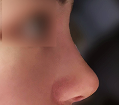 Nose surgery was the perfect move
