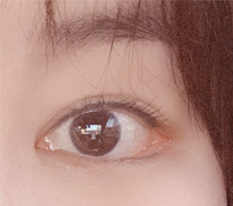 I wrote an honest review of my canthoplasty