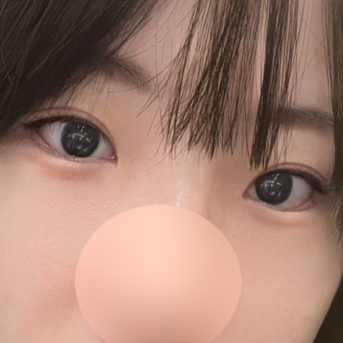 目の再手術、現代美学整形外科で成功！切開再手術＋目尻下まぶた切開＋眼瞼下垂矯正 ✔