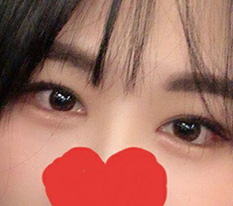 デュアル切開に大満足のレビュー^^