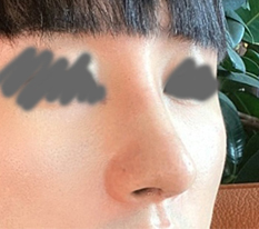 鷲鼻を直したら、男らしくなったと言われました