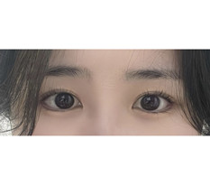 外下眼角切開の術後レビューです~~~