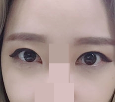 二重手術とデュアル切開を受けました！