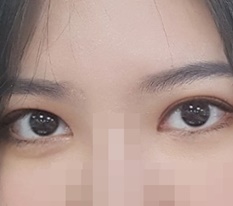 切開二重、目頭切開のレビューです : )