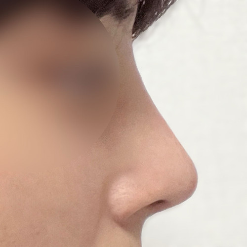 男性の初めての鼻整形チャレンジ記