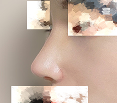 Hump nose correction