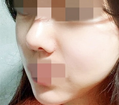 輪郭手術しました、レビューを上げます ㅎㅎ