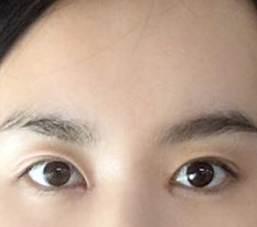 It will soon be a month since I had a forehead lift