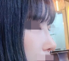 o0o 鼻手術から1ヶ月の経過!!