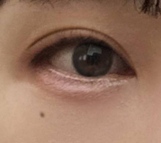 切開二重が正解でした