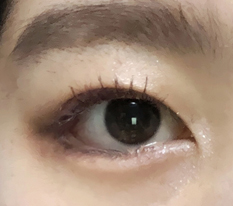 後下目尻切開に満足！