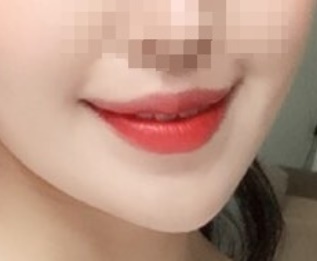 口角手術レビュー!!!!
