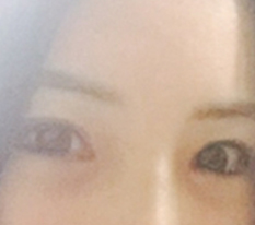 目の再手術を受けましたㅠㅠㅠㅠ