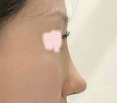 鼻の手術後の感想を書いてみます どうですか？？