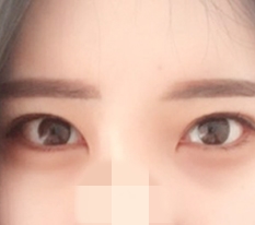 目尻切開と下眼瞼切開！