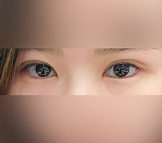目の手術で印象が変わりました