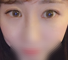 One-month review after eye surgery/front canthoplasty~~~~~