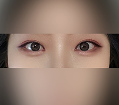 ラインが前はかなり濃すぎましたㅠ
