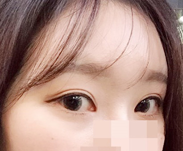 目の手術最高>.<