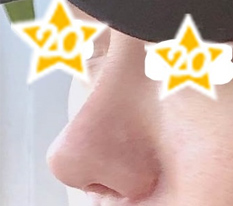男は鼻！現代美学整形外科で成功しました