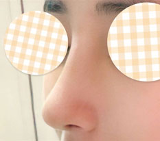 ハイコを除去して鼻の手術をして本当に良かったです