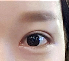 現代美学で二重と切開に成功した話~
