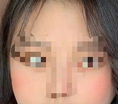 頬骨再手術を受けました~ きれいにしてくださってありがとうございます^^