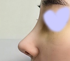 鼻の再手術から2週間経ちました~~！